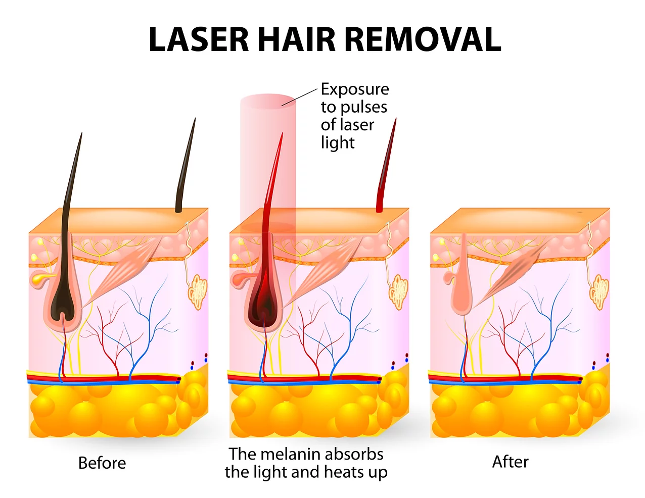 laser-hair-removal-process